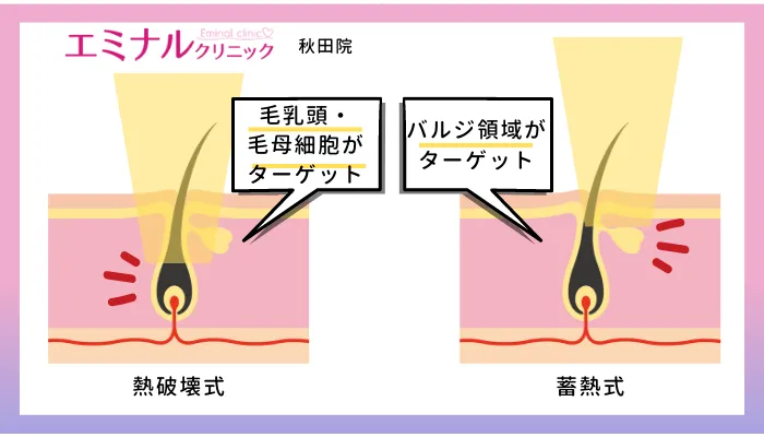 エミナルクリニック秋田熱破壊式と蓄熱式