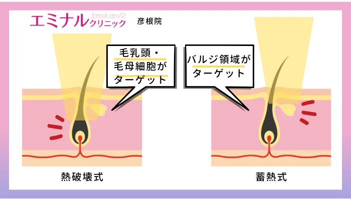 エミナルクリニック彦根熱破壊式と蓄熱式