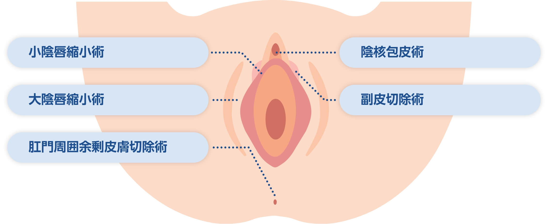 ビラビラ はみ出 てる