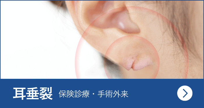 耳垂裂 耳切れの手術専門 東京 池袋 渋谷 新宿 上野 で日帰り手術なら アイシークリニック