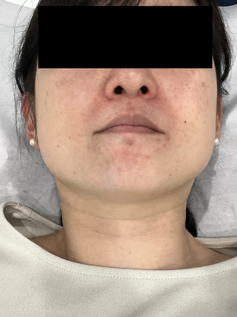 【症例紹介】30代女性・あご下のニキビ（慢性ニキビ）に対するアグネス治療（2025年8月3日更新）