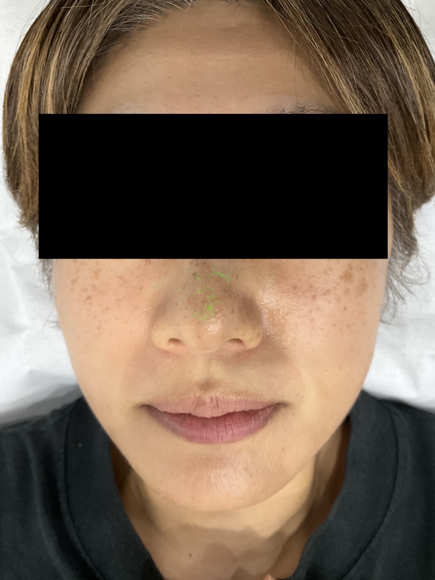 【症例紹介】40代女性・顔全体のシミに対するQスイッチYAGレーザー治療（2025年8月3日更新）