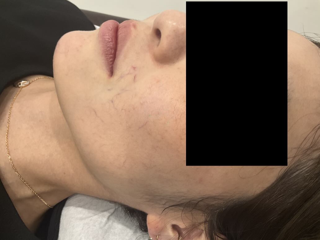 【症例紹介】30代女性・顔の毛細血管拡張症に対するVビーム治療（2025年8月14日更新）