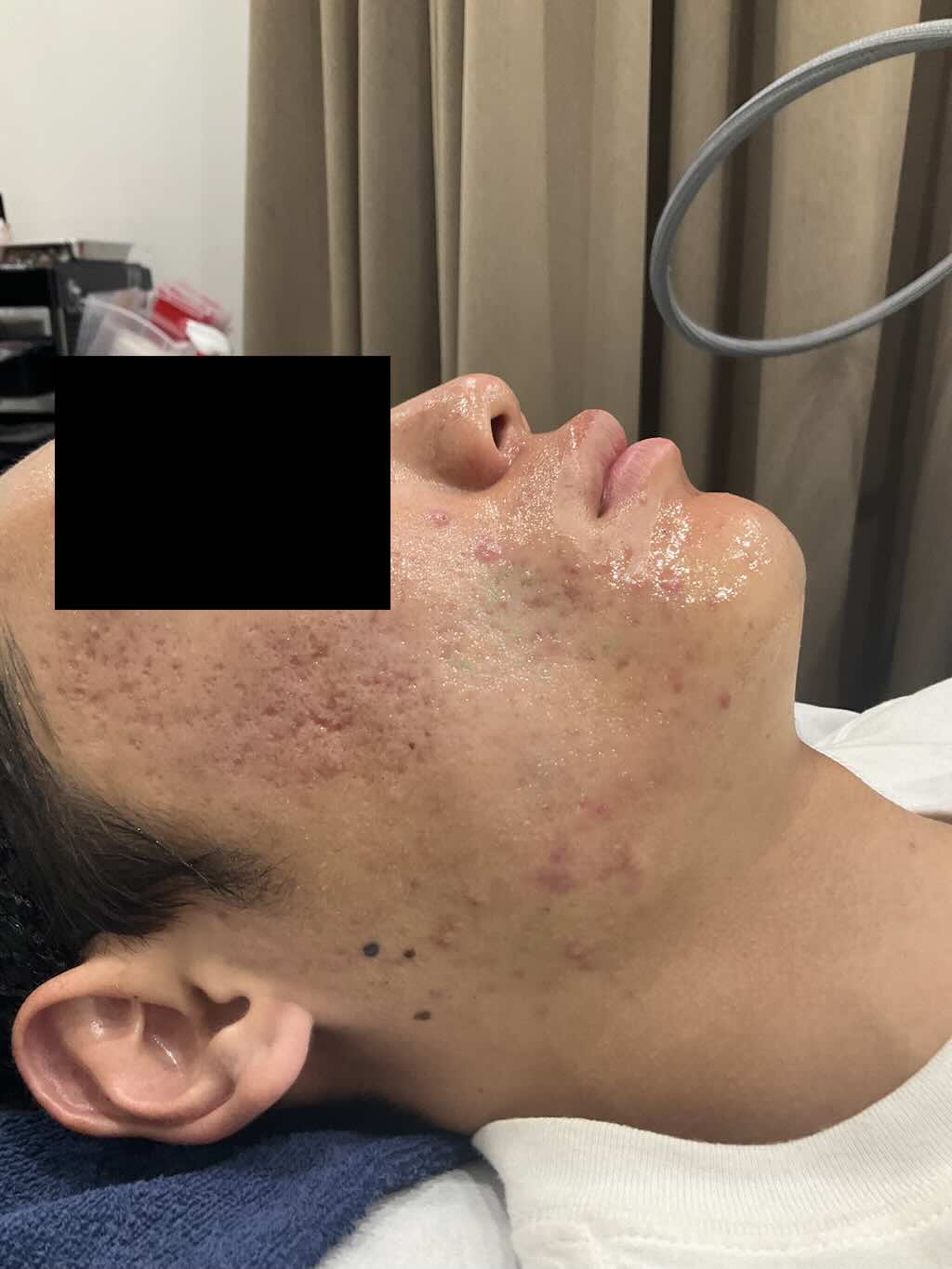 【症例紹介】30代男性・顔のニキビ跡に対するダーマペン治療（2025年8月14日更新）