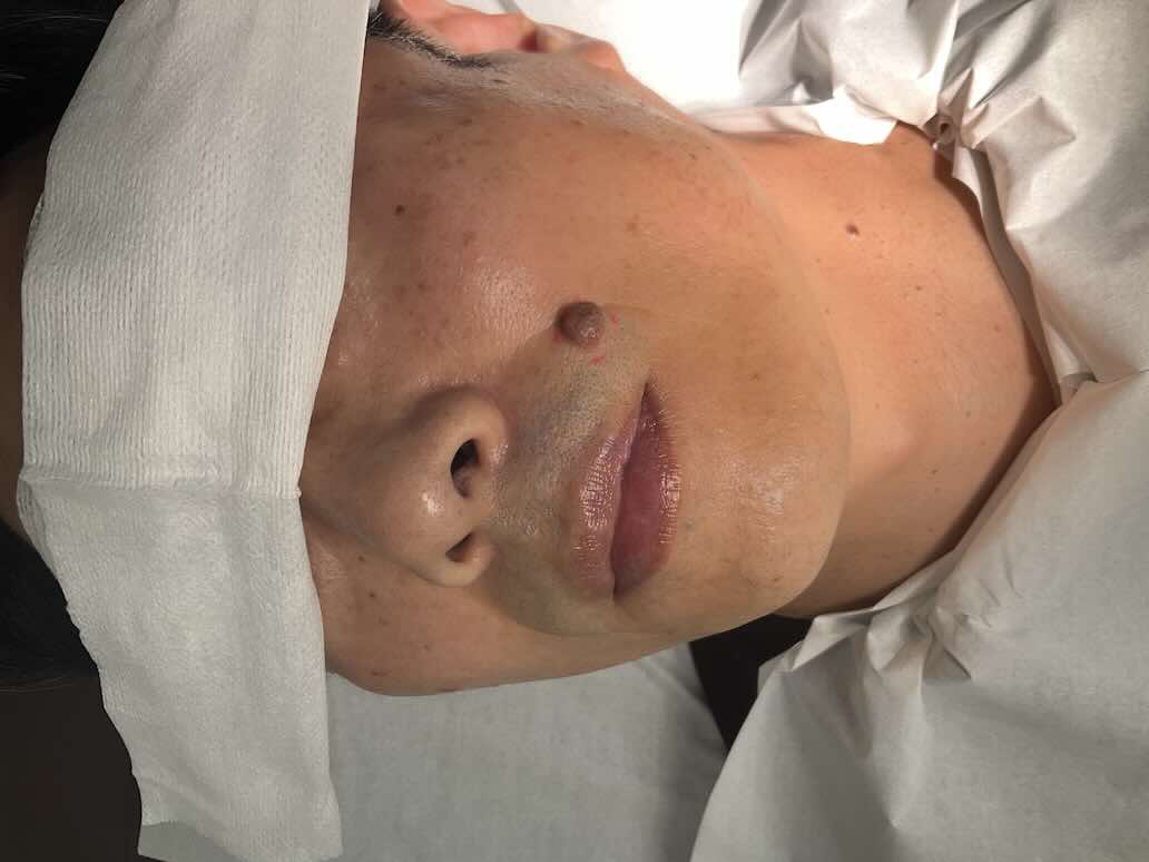 【症例紹介】30代男性・顔のほくろに対する外科的切除（オペ）治療（2025年8月14日更新）術前