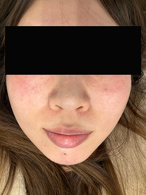 【症例紹介】20代女性・ほほの赤み・赤ら顔（酒さ様皮膚炎）に対するVビーム治療（2025年8月3日更新）